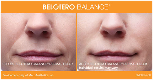 BELOTERO_BandA_Full_Front_01