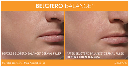 BELOTERO_BandA_Full_Front_02